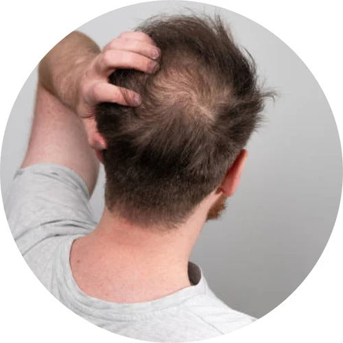 Hair Fall and Thinning