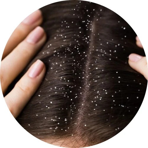 Dandruff
